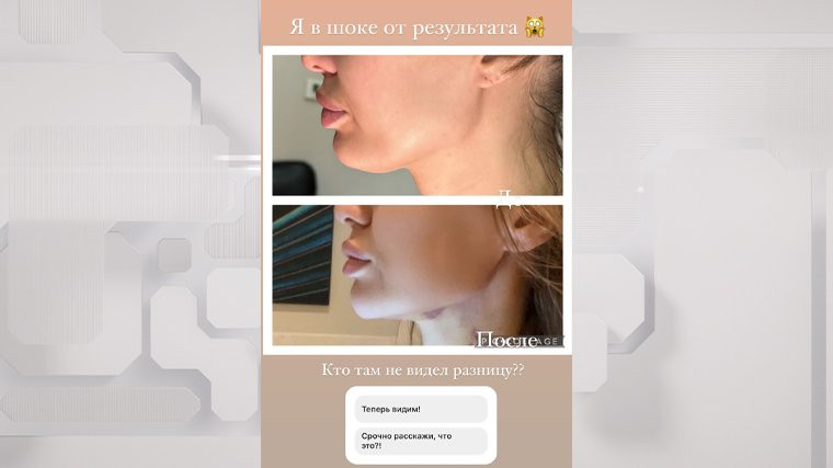 Телеведущая Виктория Боня показала результат от своей первой пластической операции
