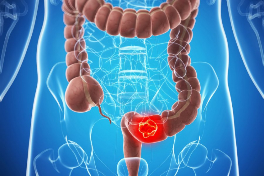 Рак толстой кишки станет самым смертоносным видом онкологии к 2030 году