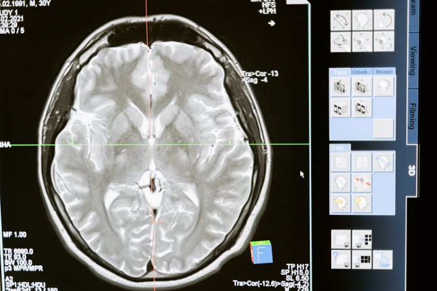 Precision Neuroscience, конкурент Neuralink, проводит клиническое исследование подключив свой нейроинтерфейс к мозгу человека
