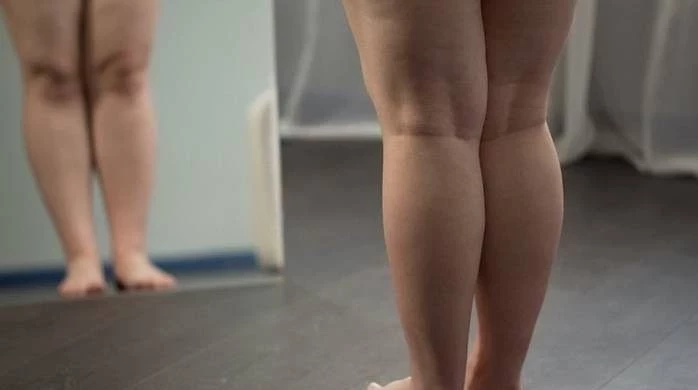 Опасные болезни, о которых может говорить лишний вес