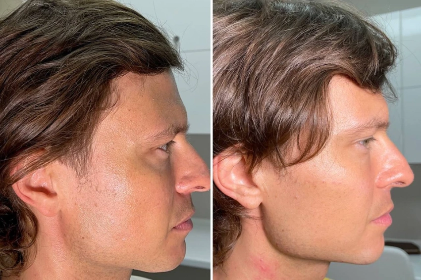 Как омолаживаются звезды: Почему у Волочковой и Шаляпина все лицо в иголках