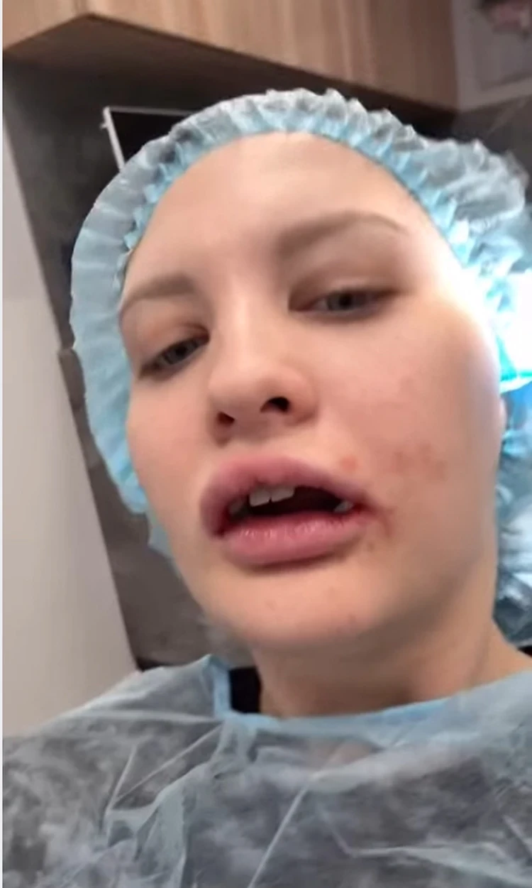 Невестка Наташи Королевой показала лицо после тяжелейшей операции на челюсти