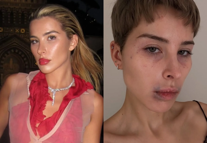 Блогер Элеонора Абрамова показала, как выглядит после удаления филлеров из лица
