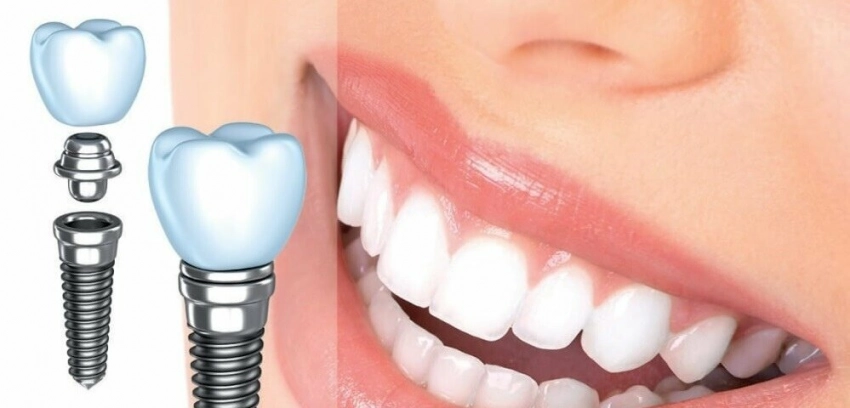 Дентальная имплантология: новая эра в восстановлении улыбки